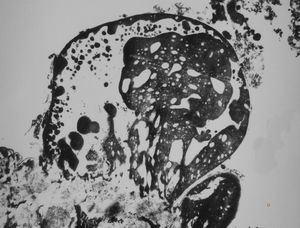 M, 63y. | cyst of choroid plexus - dystrophic calcification